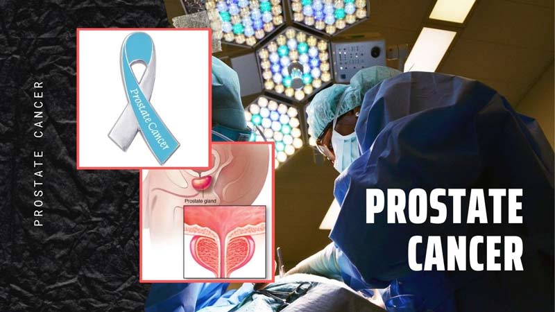 Prostate Cancer: Causes, Symptoms, Treatment, and Prevention
