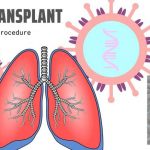 Lung Transplant: Symptoms And Procedure