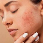How to Choose a Moisturizer for Oily Skin?