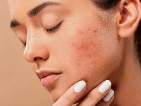 How to Choose a Moisturizer for Oily Skin?