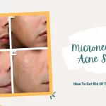Microneedling Acne Scars How To Get Rid Of Them For Good
