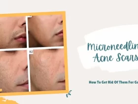 Microneedling Acne Scars How To Get Rid Of Them For Good