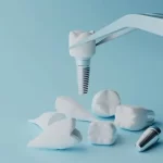 Dental Implants - A Path To Better Health